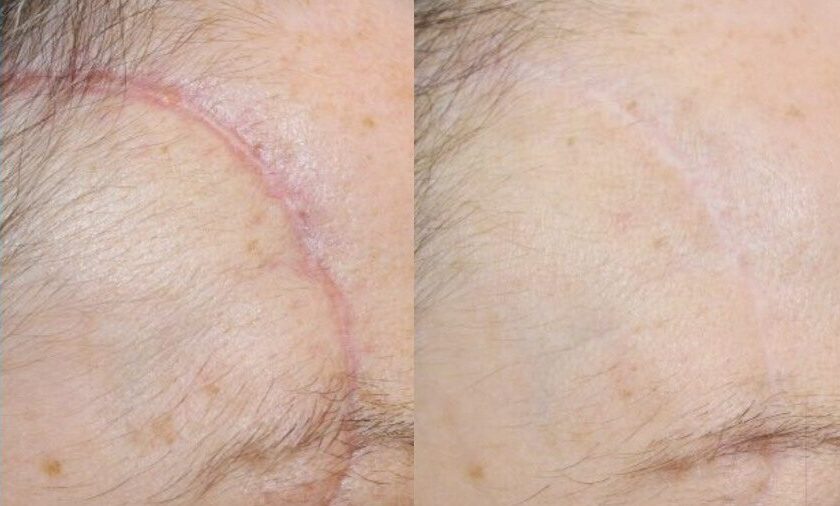 Laser-Scar-Treatment-1-e1695132274210.jpg